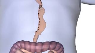 Esophagectomy Procedure Animation [upl. by Gentille]