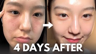 How I repair my skin barrier in 4 days at home with affordable skincare routine [upl. by Annawat53]