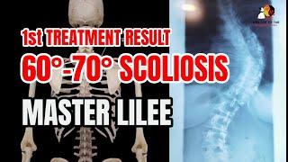 60°  70° SCOLIOSIS Treatment by MASTER LILEE 1ST Treatment RESULT WahTohTitTar [upl. by Achilles]