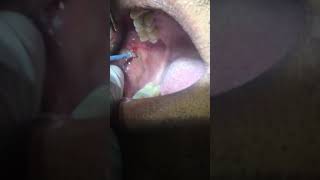 Removal of Leukoplakia Patch using RF Electrosurgery Unit Dr Ankit Goel Hapur [upl. by Llenod]