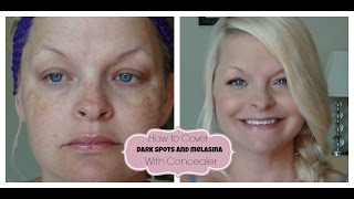 How to Cover Dark Spots  Melasma with Concealer [upl. by Nnaeilsel]