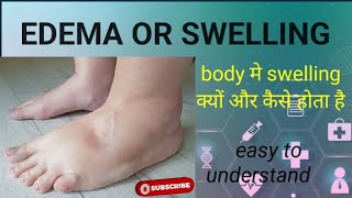 Edema or Swelling Edema kya hota hai Cause of Edema Pathophysiology of edema [upl. by Notsirk]