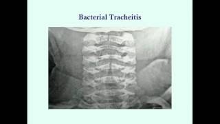 Bacterial Tracheitis  CRASH Medical Review Series [upl. by Monagan]