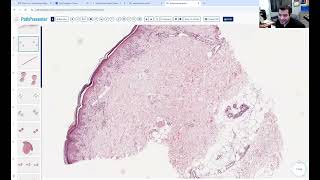 Avi Bitterman Dermpath Lecture 5 Interface [upl. by Sheffie]