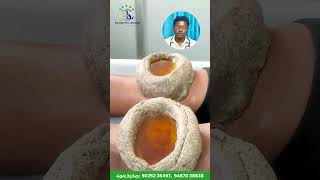 மூட்டு வலிஇயற்கை மருத்துவ சிகிச்சையில் தீர்வு kneepain pain arthritis acupuncture ulundurpet [upl. by Roch499]