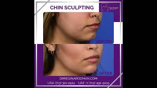 Chin Sculpting [upl. by Polloch]