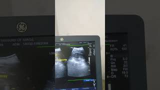 Renal Angiomyolipoma ultrasound [upl. by Hauge]