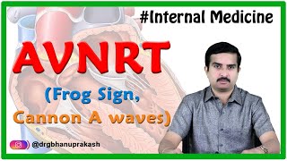 Atrioventricular nodal reentrant tachycardia AVNRT  Internal medicine National USMLE Step 2 ck [upl. by Eniroc]