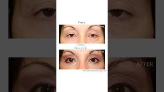 Most Common Cause of Eyelid Ptosis droopyeyelids [upl. by Imuy]