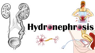 Hydronephrosis  Definition Functional Anatomy Causes Signs amp Symptoms Diagnosis amp Treatment [upl. by Anivlem530]