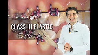 Orthodontic class III elastic step by step by Dr Amr Asker rubberbands [upl. by Rheingold823]