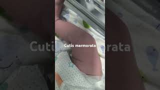 Cutis marmoratanewborn paeds clinical [upl. by Anitnahs254]