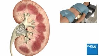 How extracorporeal shockwave lithotripsy is used to treat kidney stones  Bupa Health [upl. by Bristow]