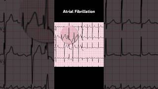 Atrial Fibrillation ECG Ashman phenomenon [upl. by Valorie]