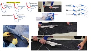 Rotational atherectomy advanced techniques with videos  Orbital atherectomy tips Elias Hanna [upl. by Yennaiv146]