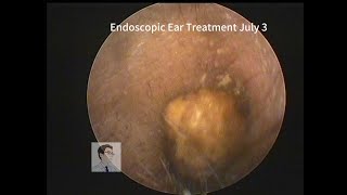 asmr ear cleaning Cerumen embolism in adults20230703 [upl. by Ashton645]