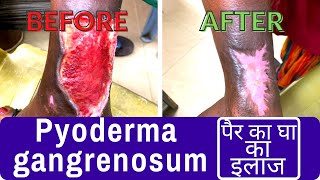 Pyoderma gangrenosum  large leg ulcer treatment  पैर का घा का इलाजDr Uttam Kumar Lenka [upl. by Eita29]