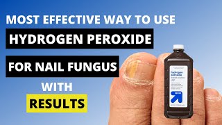 3 Ways to Use Hydrogen Peroxide for Nail Fungus  Toe Fungus Journey [upl. by Halden]