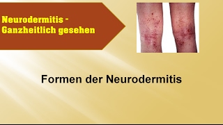 Formen der Neurodermitis  GANZMEDIZIN Naturheilpraxis [upl. by Bethel]