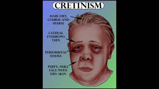 Cretinism disease 11thNEET PCS [upl. by Cappella]