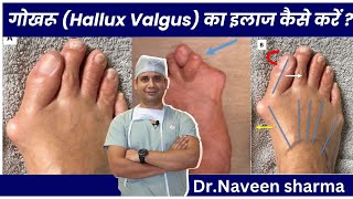 hallux valgus TREATMENT AT HOME [upl. by Lurette]