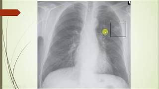 Histoplasmosis a clinical case based review geography symptoms differential diagnosis treatment [upl. by Alehtse]