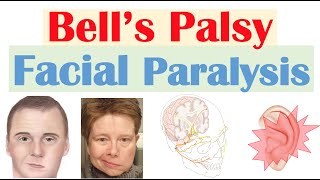 Bell’s Palsy Facial Paralysis  Causes Pathophysiology Signs amp Symptoms Diagnosis Treatment [upl. by Ashlie75]