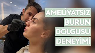 Hastamızın Burun Dolgusu Deneyimi  DrErsin Aydın  Green Klinik [upl. by Enamrahc236]