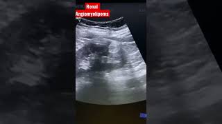 Renal Angiomyolipoma  kidney ultrasound [upl. by Drofhsa]