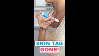 Removing skin tags with TagBand Auto  How to use [upl. by Soracco]