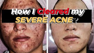 HOW I CLEARED MY SEVERE ACNE WORKS  BEFORE AND AFTER PICTURES EPIDUO amp SALICYLIC ACID REVIEW PH [upl. by Eitsrik]