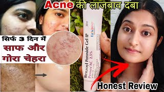 Benzoyl Peroxide Gel Honest Review  Benzoyl peroxide gel 25 Pernex  Benzoyl peroxide for acne [upl. by Niaz]