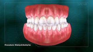 Tooth Whitening Process [upl. by Anialed213]