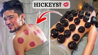 ASMR I Experienced HARDCORE Cupping Therapy That Gave Me Intense Hickeys 😉 [upl. by Ern]