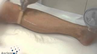 MeDioStar NeXT  Training video for hair removal legs from Asclepion [upl. by Lorollas]