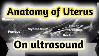 Sonographic Anatomy of UterusGyneacological ultrasound [upl. by Latimer845]