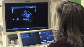 What Is a Fetal Echochardiogram Test [upl. by Bohner]