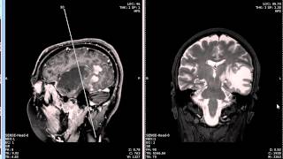 Homonymous hemianopsia caused by tumor [upl. by Euqinad]