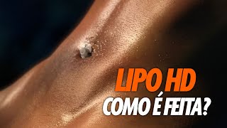 COMO E FEITA A CIRURGIA DE LIPO HD CIRURGIA PLASTICA [upl. by Hana]