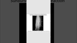 Sunburst periosteal reactionosteosarcoma radiology orthopedics [upl. by Yemrej387]