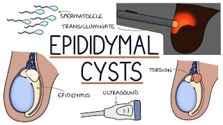 Understanding Epididymal Cysts [upl. by Itisahc879]