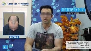 FUE Hair Transplant Review After 7 Months Of Procedure  Laser Inn Aesthetic [upl. by Aisatna]