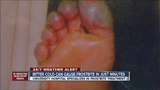 Bitter cold can cause frostbite in just minutes [upl. by Lindley]