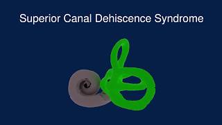 Superior Canal Dehiscence Syndrome SCDS [upl. by Etnemelc]