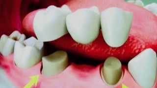 Dental Bridges  How to properly clean your teeth [upl. by Eletnahc]