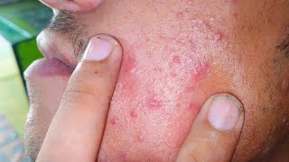 sac be spa blackheads elderly 2024  sac be spa old age blackheads 2024  sac be spa thuy 624 [upl. by Elegna]