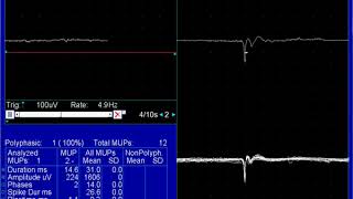 Positive Sharp Waves  Spontaneous Activity  ELECTROMYOGRAPHY  University of Lahore [upl. by Atazroglam955]