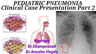 PEDIATRIC PNEUMONIA PART 2 [upl. by Eimile]