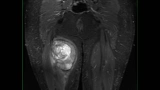 Synovial Sarcoma Thigh [upl. by Atsok741]