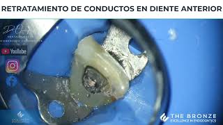 Retratamiento de endodoncia en diente anterior [upl. by Anialed]